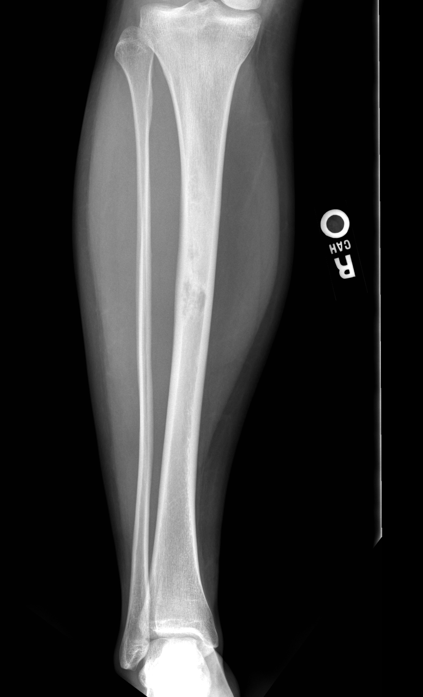 Sclerotic lesion within the anterior tibia, representative of a biopsy proven adamantinoma.