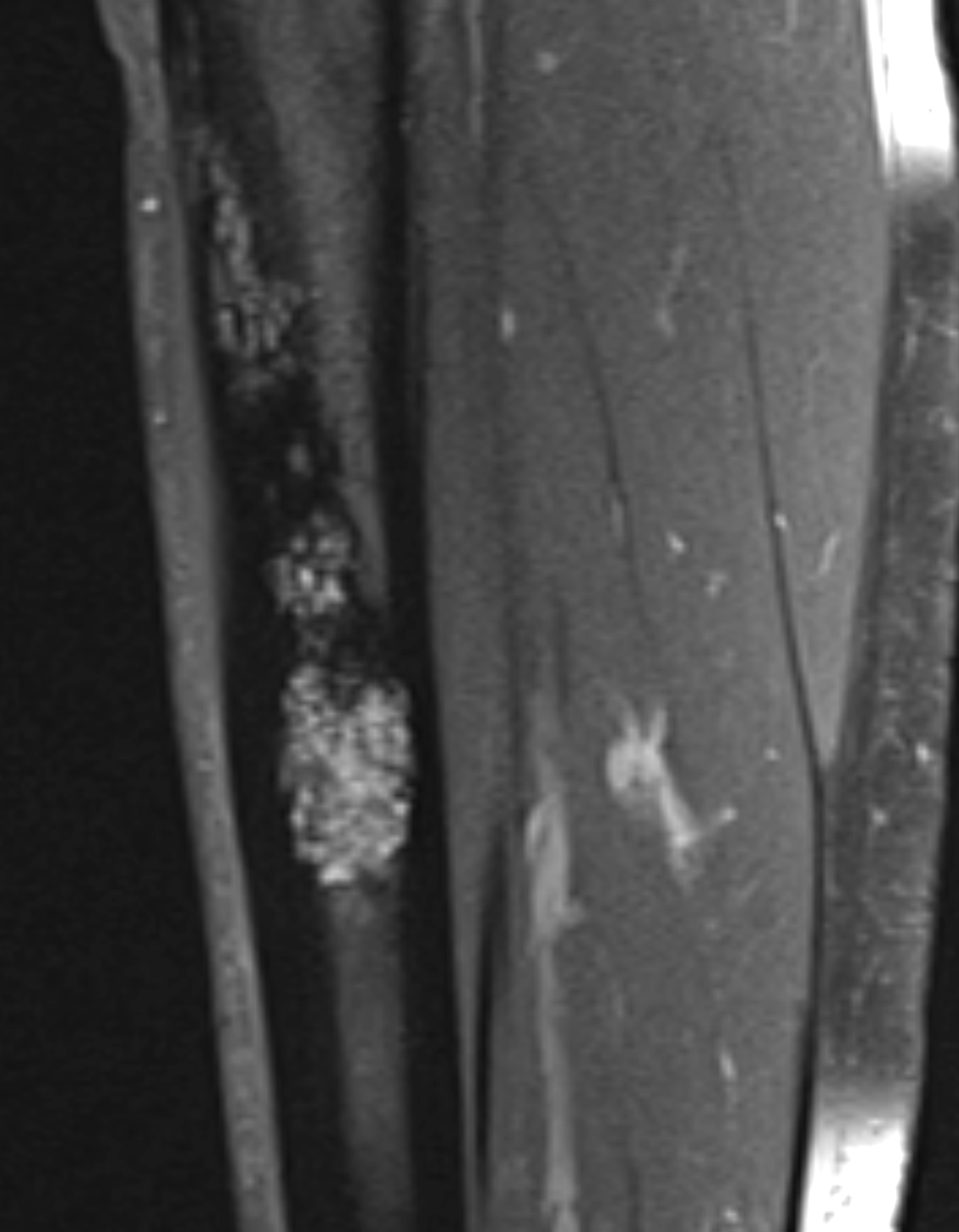 Saggital T1 with gadolinium administration