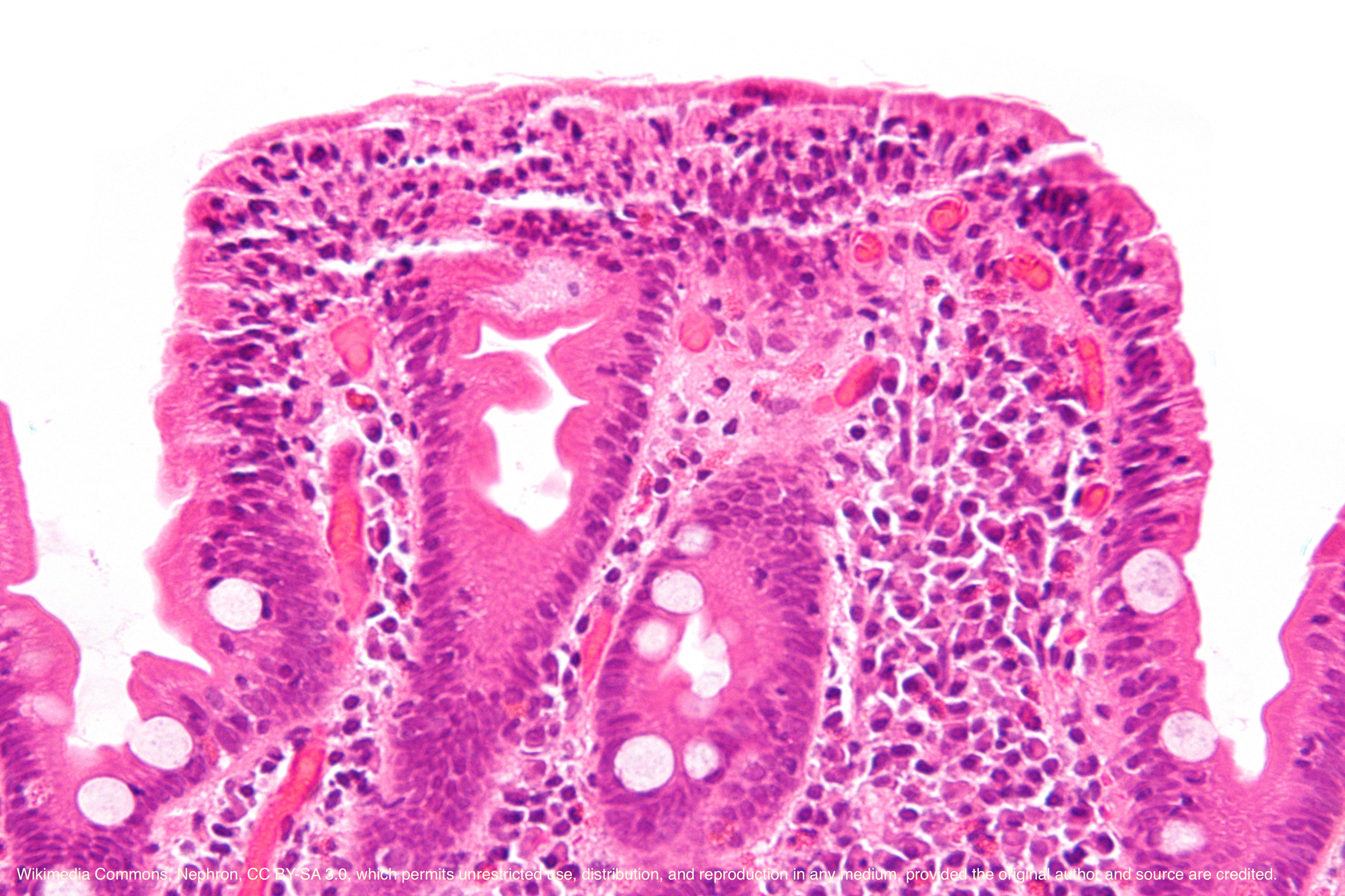 <p>High Magnification Micrograph of Celiac Disease