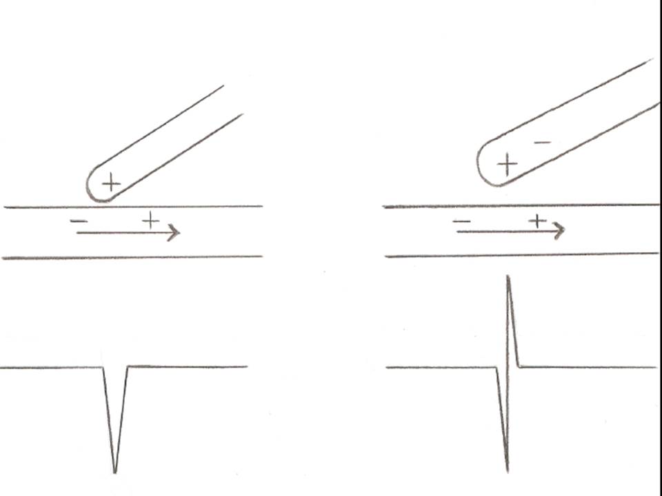 <p>Unipolar and Bipolar Electrogram Recordings