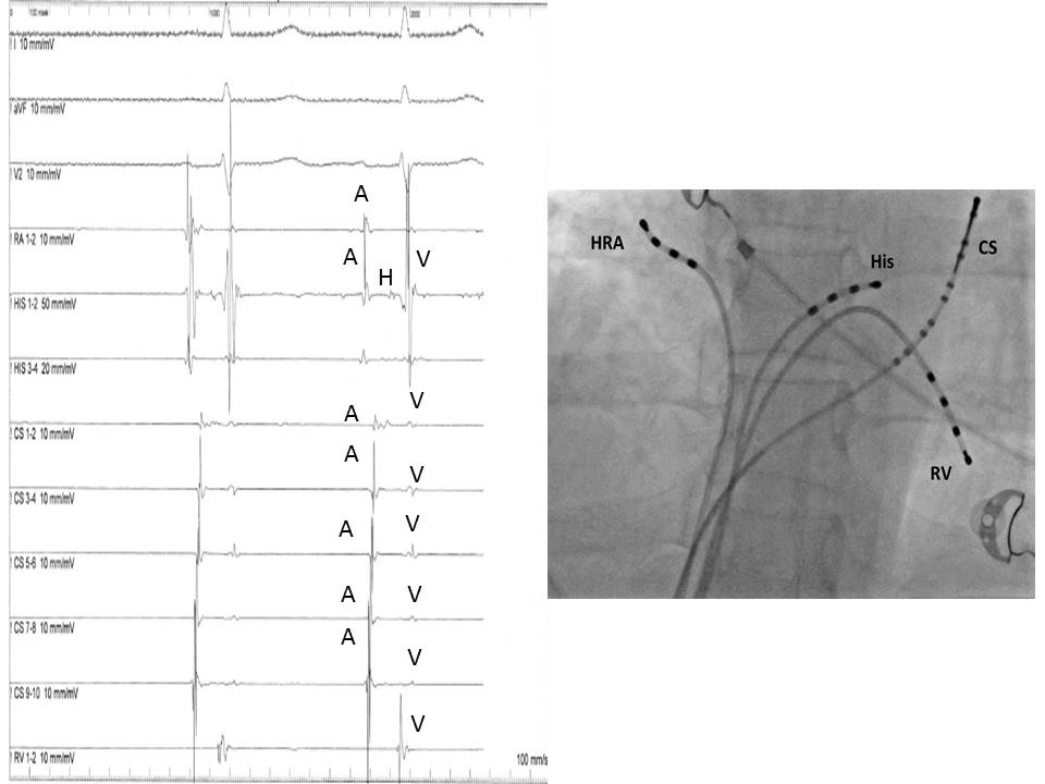 <p>Electrophysiologic Recording