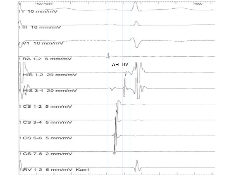 <p>His Bundle Recording. AH and HV intervals are shown in the His bundle recording.</p>