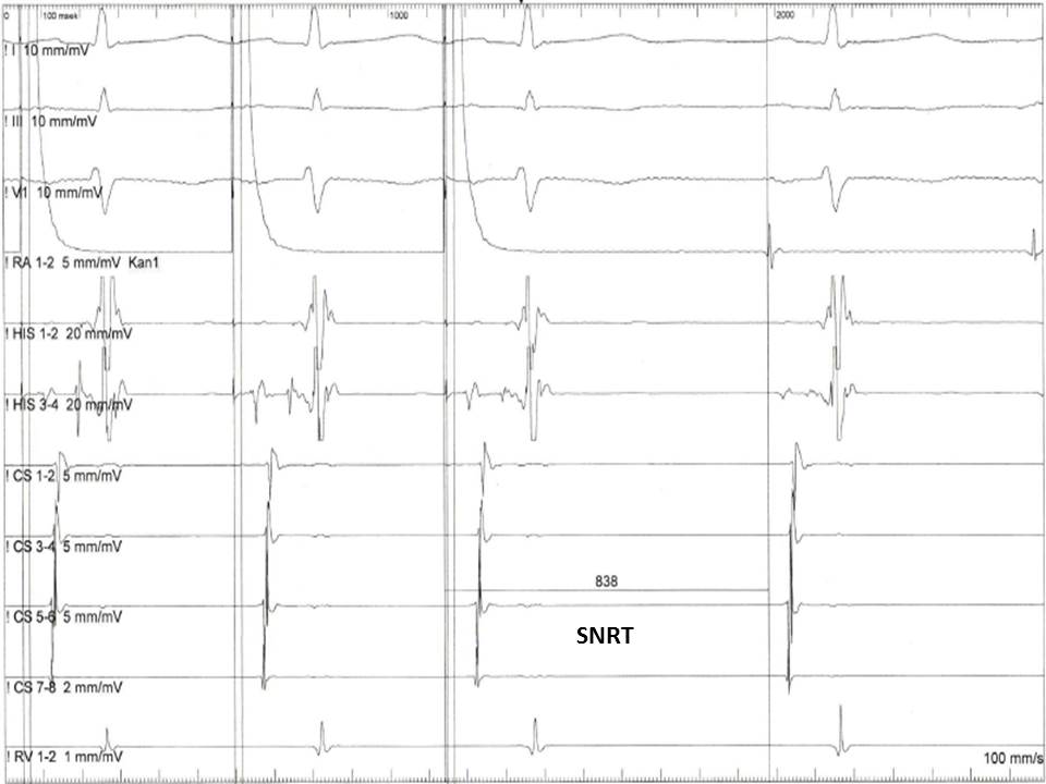 <p>Measurement of the Sinus Node Recovering Time