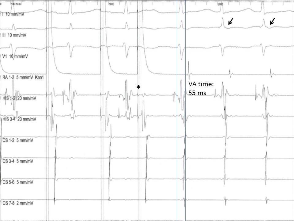 <p>Induction of an Atrioventricular Nodal Reentry Tachycardia