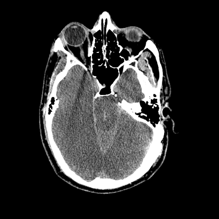 <p>Computed Tomography Scan of a Duret Hemorrhage