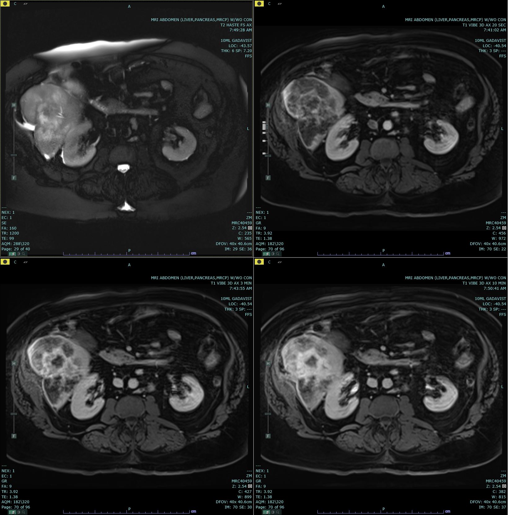 <p>Axial T2 Haste and 20s, 3-minute, and 10-minute Post-Contrast