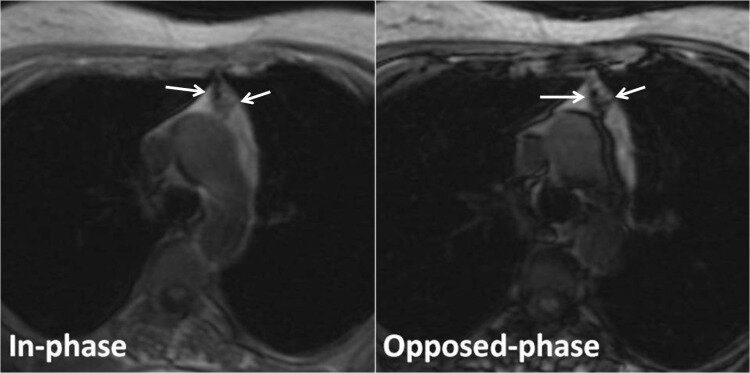 <p>Hyperplasia in a 40-Year-Old Woman With Myasthenia Gravis.</p>