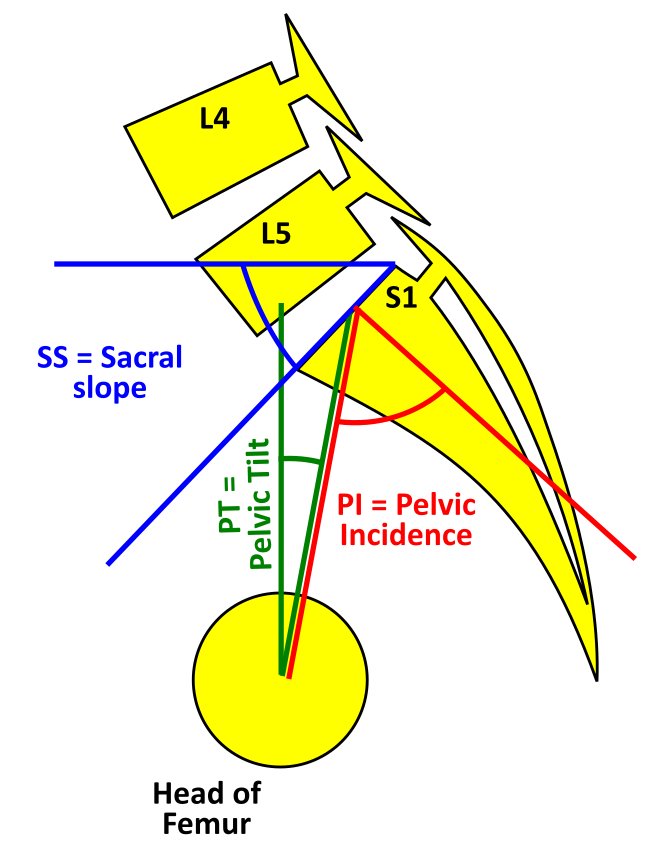 <p>Spinopelvic Parameters
