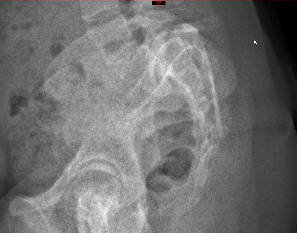 <p>Lumbar Spine Lateral X-Ray
