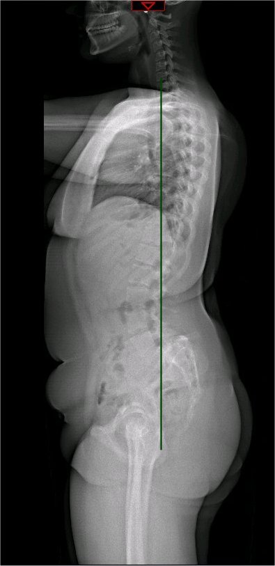 <p>Whole Spine Radiograph