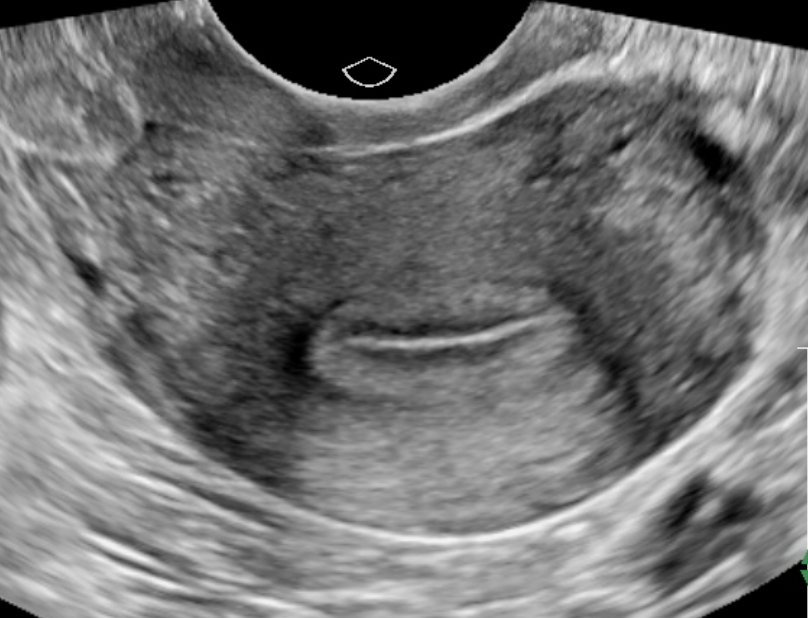 <p>Transverse/Coronal View of the Uterus.</p>