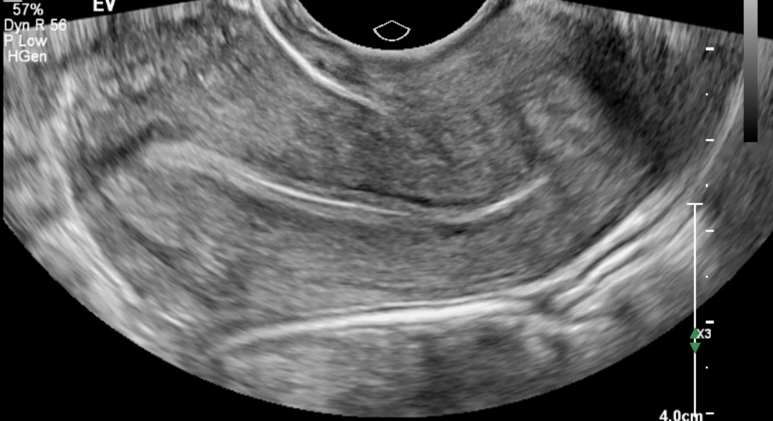 <p>Transvaginal Longitudinal View of the Uterus.</p>