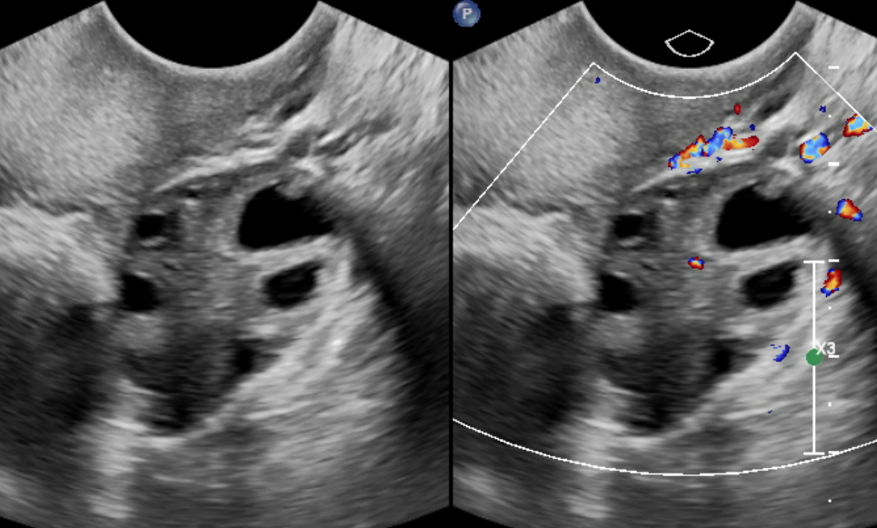 <p>Sonographic Image of the Right Ovary With and Without Doppler Evaluation.</p>
