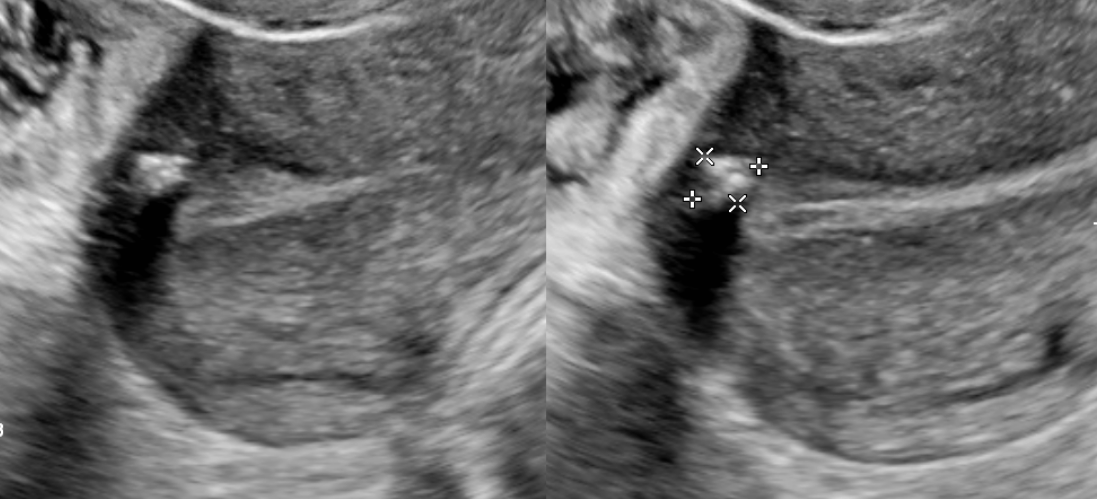 <p>Calcified Fibroid. Sonographic image demonstrating a calcified fibroid.</p>