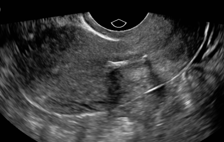 <p>Sonographic Evaluation of the Uterus Demonstrating a Malpositioned Intrauterine Device