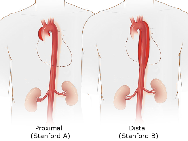 <p>Stanford Classification of Aortic Dissection