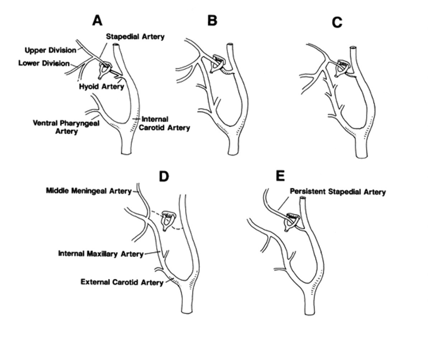 <p>Stages of Stapedial Artery Development
