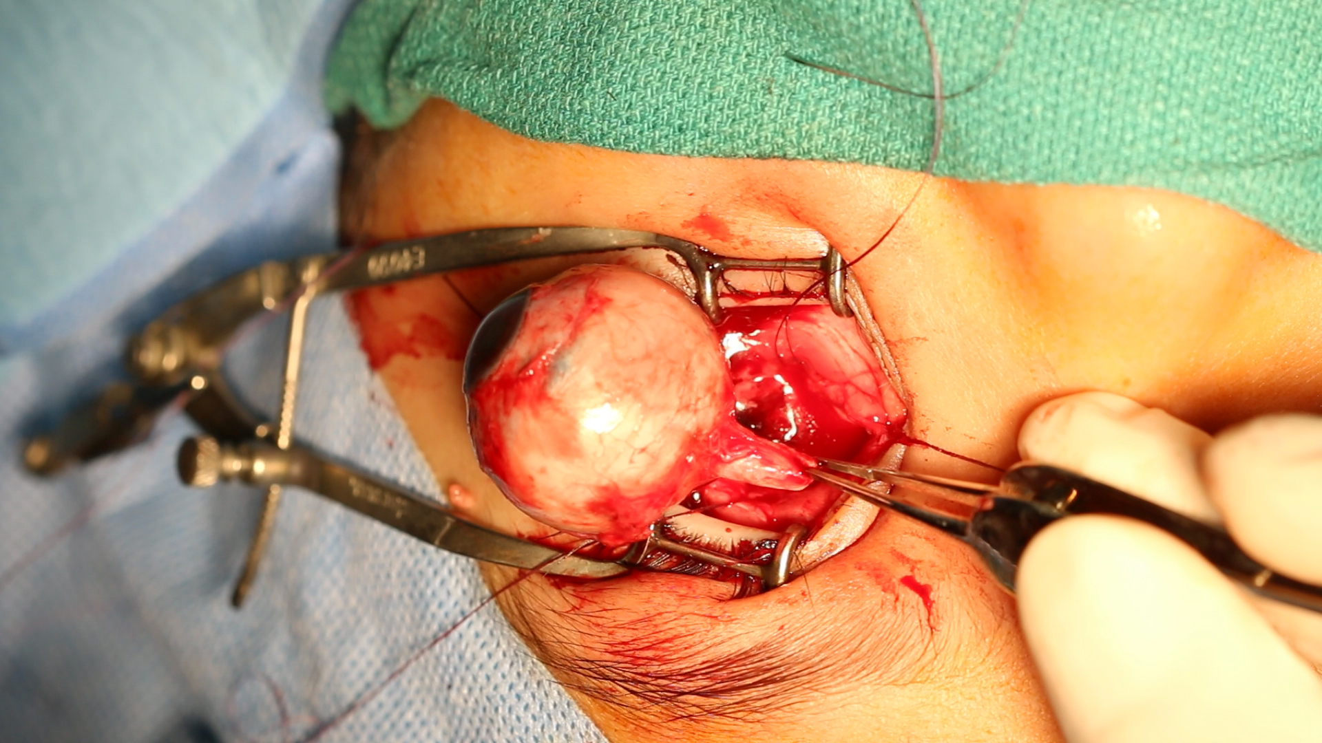 <p>Enucleation