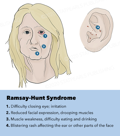 Ramsay-Hunt Syndrome