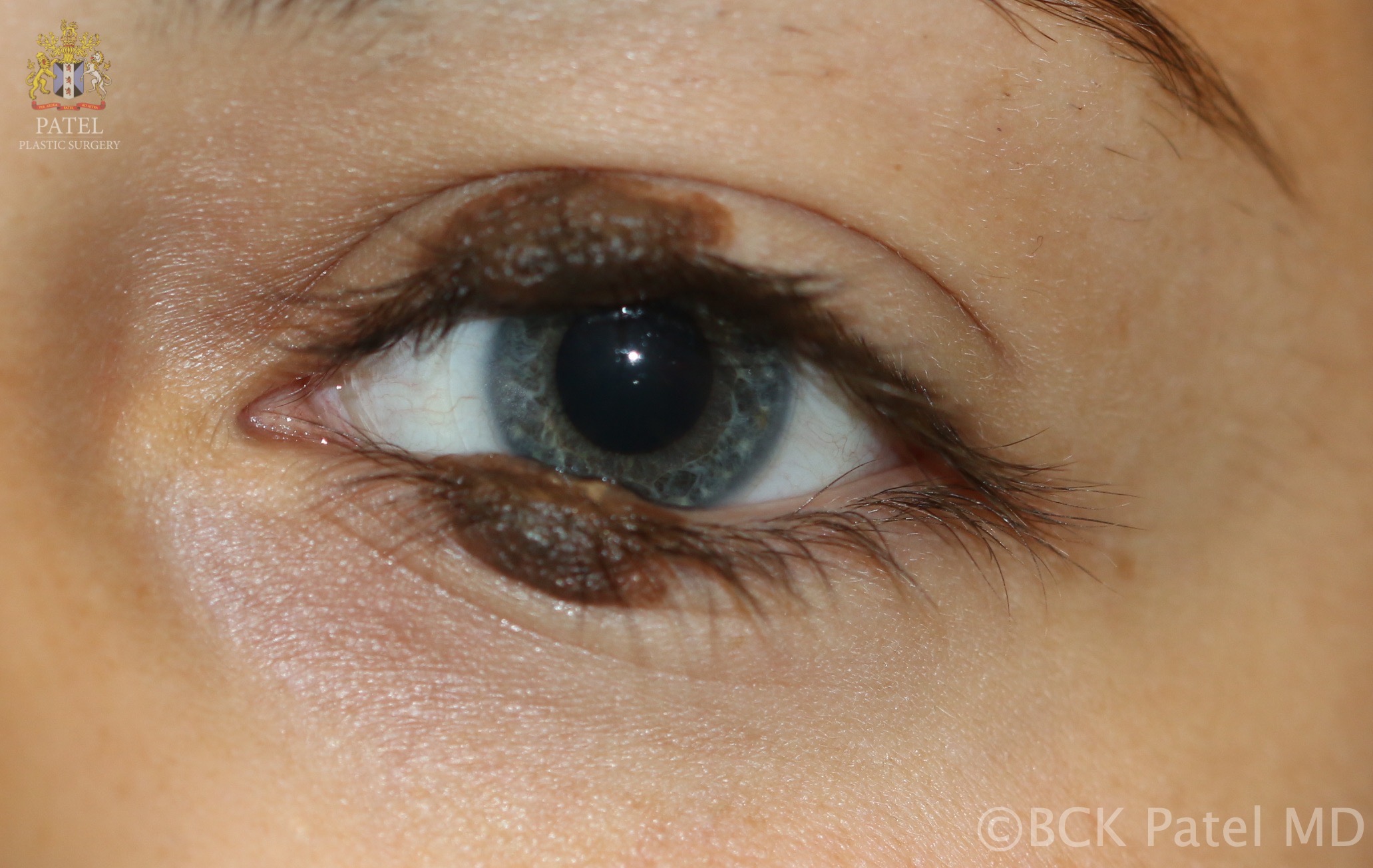 <p>Congenital Melanocytic Nevus, "Kissing Nevus" Type
