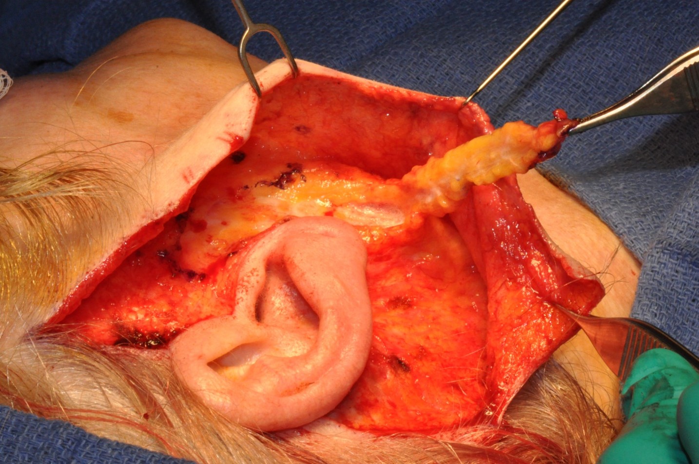 <p>Inferiorly Based SMAS Flap, Extending from Zygomatic Arch to Mandibular Angle