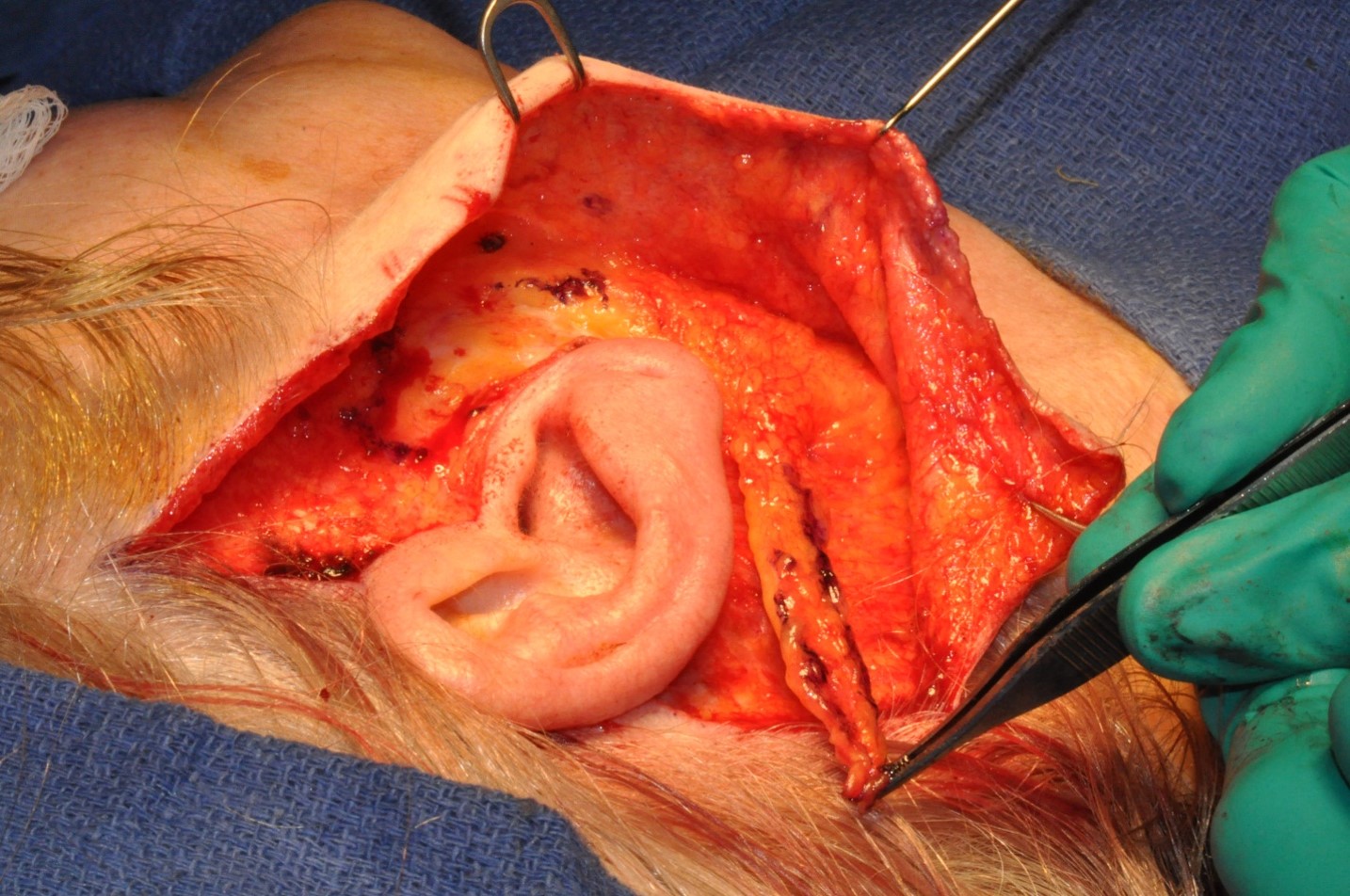<p>SMAS Flap Transposition to Mastoid, Tightening Mandible Contour and Effacing Jowl