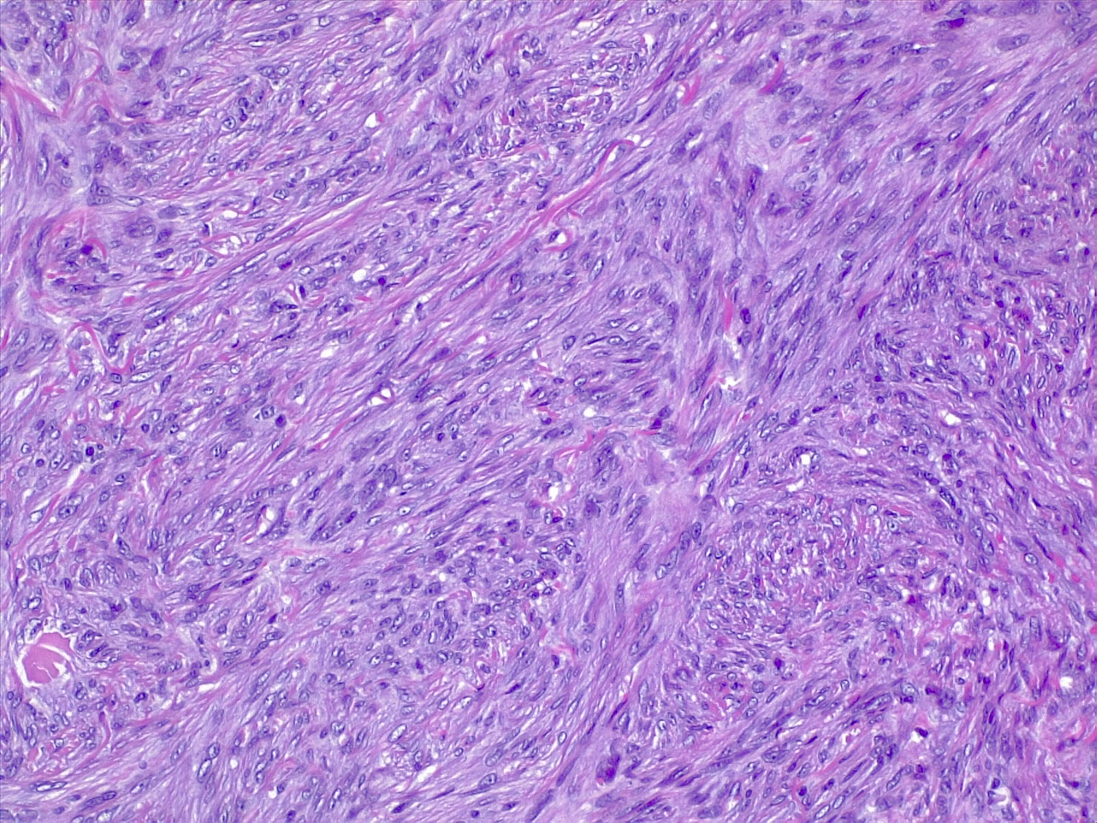 Spindle cells with bland nuclear features, disposed in short fascicles. H/E stain.