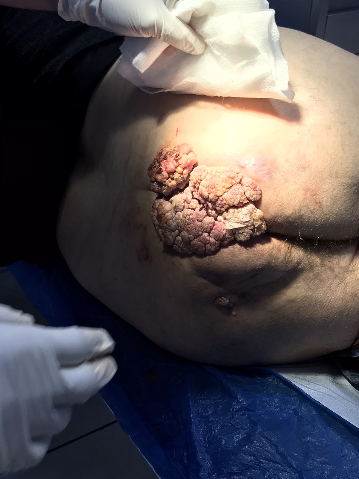 <p>Anal High-Grade Squamous Intraepithelial Lesions