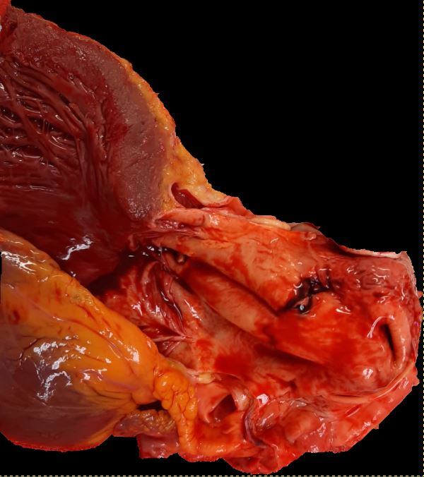 <p>Type A Aortic Dissection