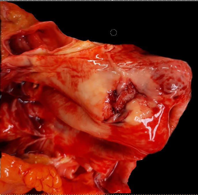 <p>Aortic Dissection, Type A