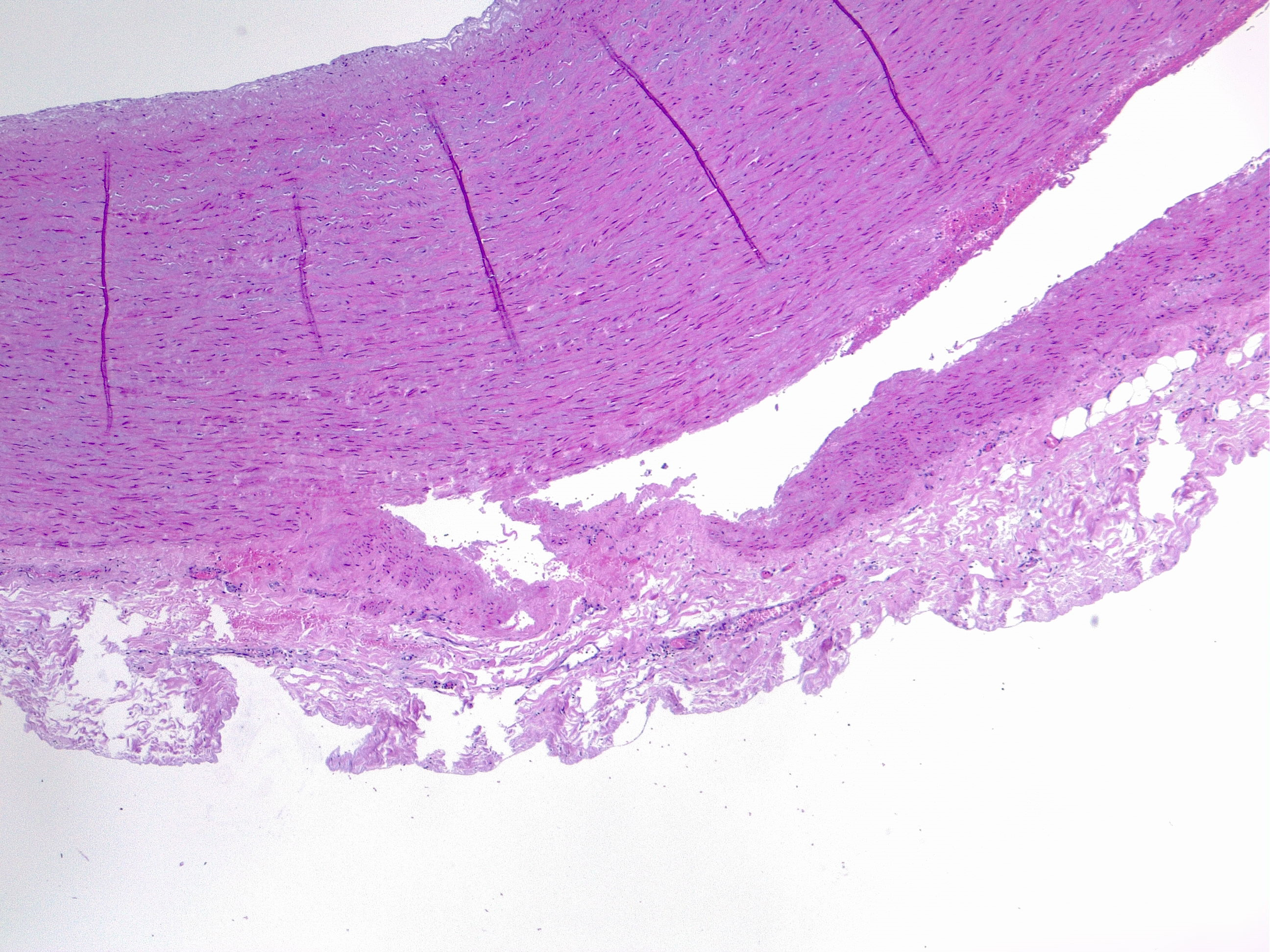 <p>Histologic Image of Aortic Dissection