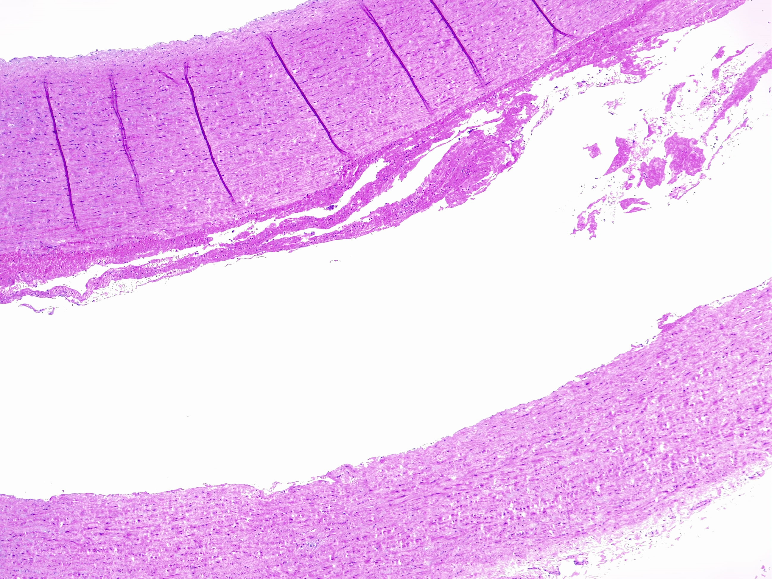 <p>Aortic Dissection Seen in Histology