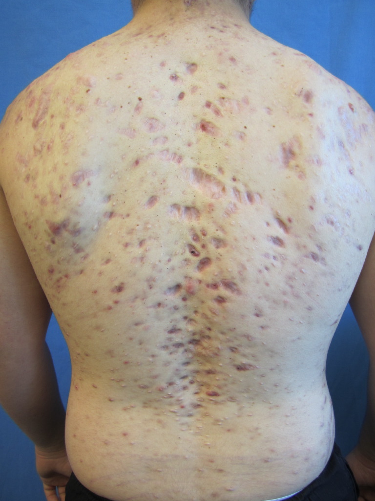<p>Acne Scarring on the Back