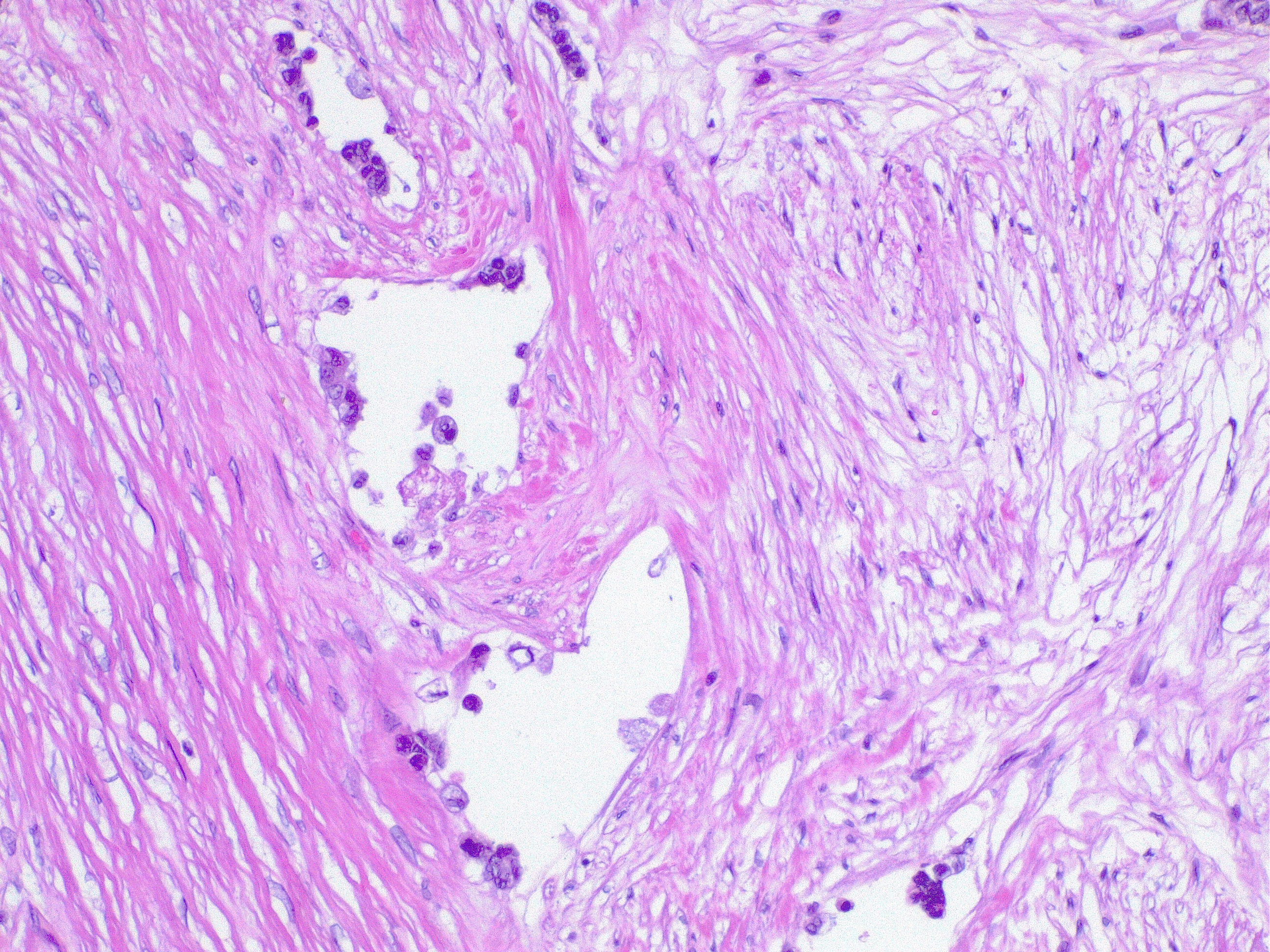 <p>Lymphatic Invasion in Colorectal Cancer
