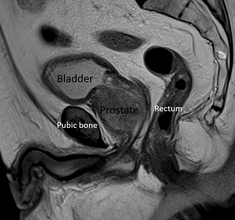 <p>Midsagittal Image of Prostate on MRI.</p>