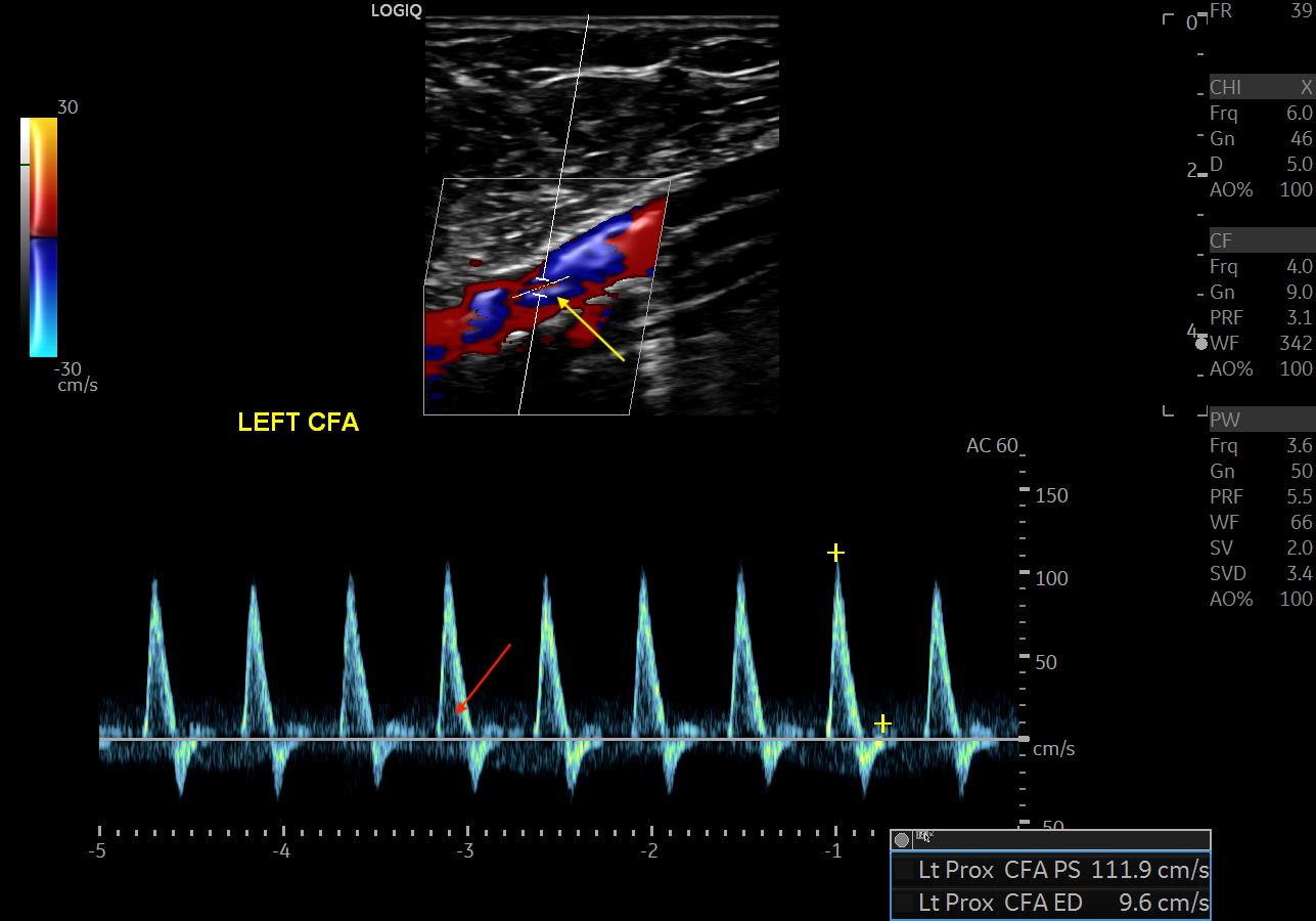 <p>Typical Triphasic Waveform