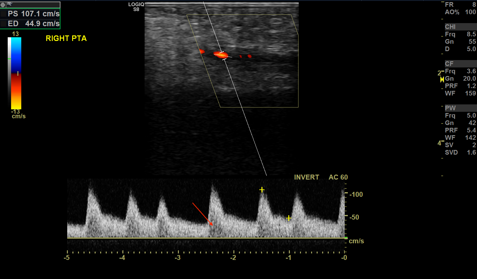<p>Monophasic Waveform