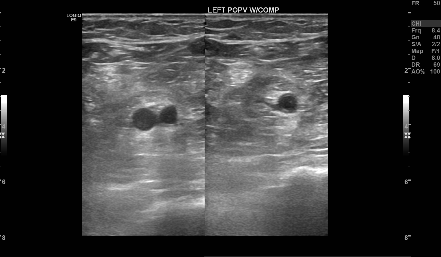<p>B-Mode Doppler Showing the Left Popliteal Vein Under Compression. This compressibility is a normal finding.</p>