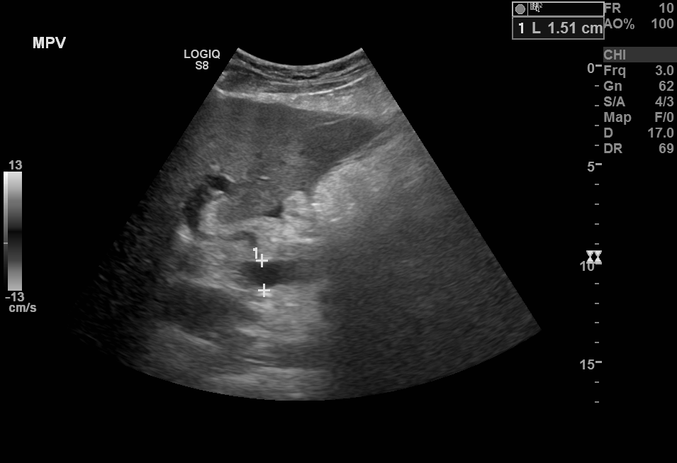 <p>Portal Hypertension