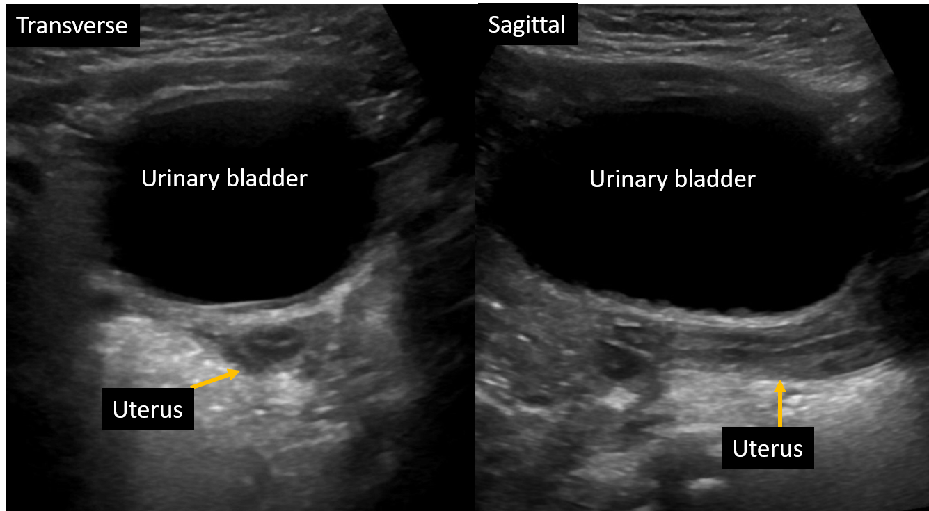 <p>Transabdominal Ultrasound of Normal Tubular-Shaped Uterus in a 2-Year-Old Female