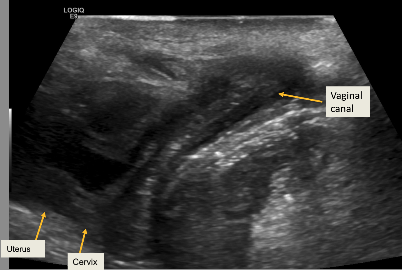 <p>Translabial Ultrasound Showing Normal Pelvic Anatomy in a 2-Year-Old Female