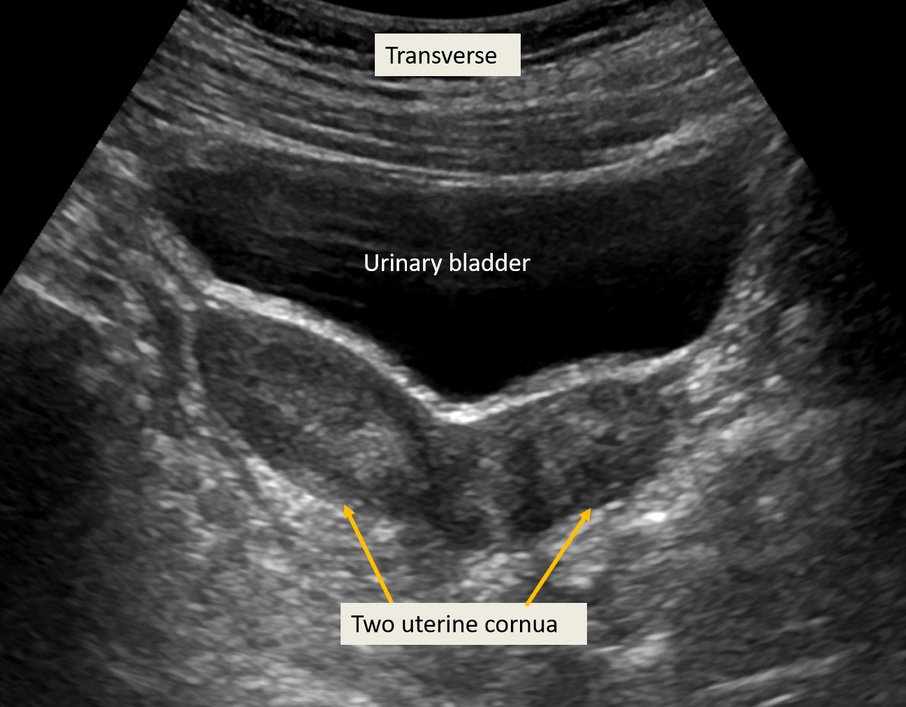 <p>Transabdominal Ultrasound of Uterine Didelphys