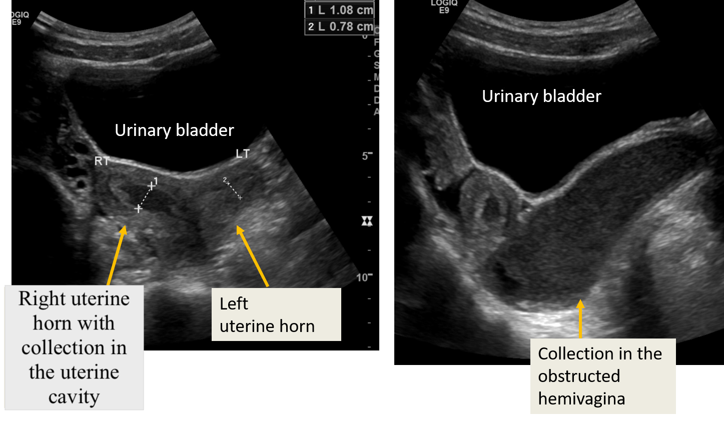 <p>Transabdominal Ultrasound of Obstructed Hemivagina With Ipsilateral Renal Anomaly