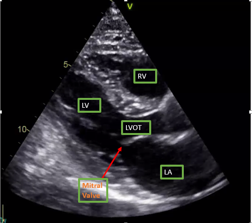 <p>Parasternal Long-Axis View on Transthoracic Echocardiography.</p>