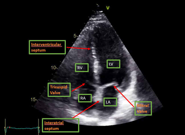 <p>Apical Four-Chamber View on Transthoracic Echocardiography.</p>