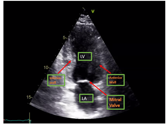 <p>Apical Two-Chamber View on Transthoracic Echocardiography.</p>