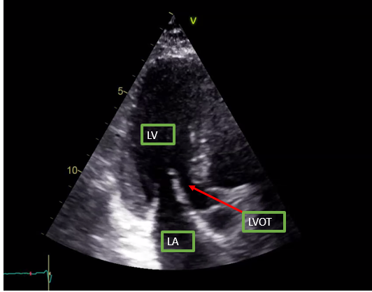 <p>Apical Parasternal Long-Axis View on Transthoracic Echocardiography.</p>