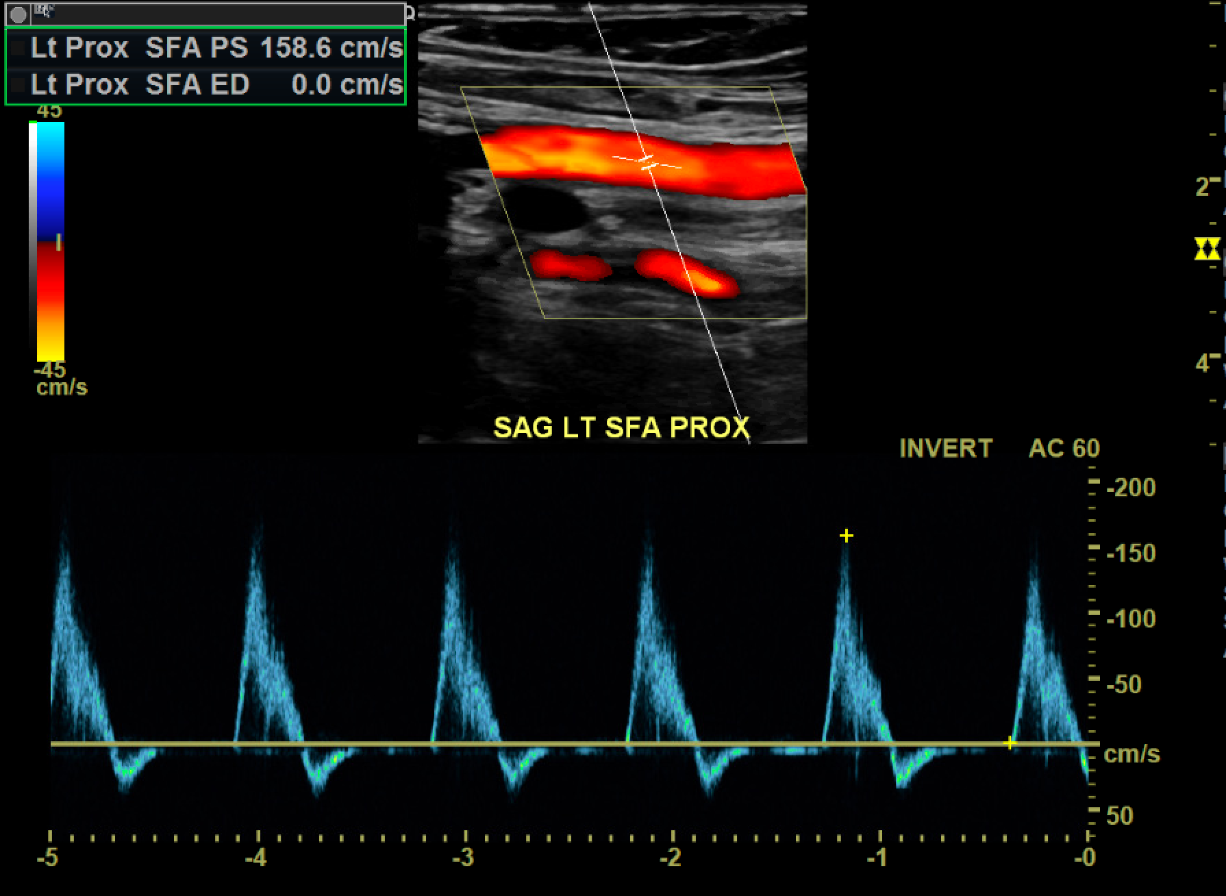 <p>Normal Triphasic Arterial Waveform</p>
