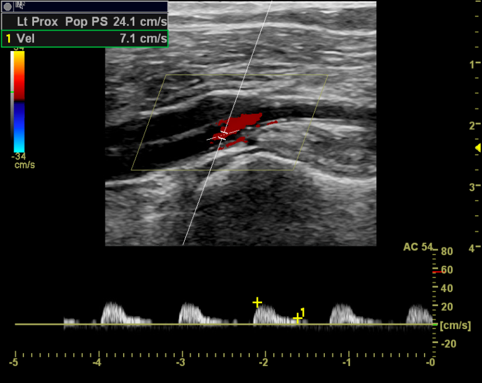 <p>Monophasic Tardus and Parvus Waveforms</p>
