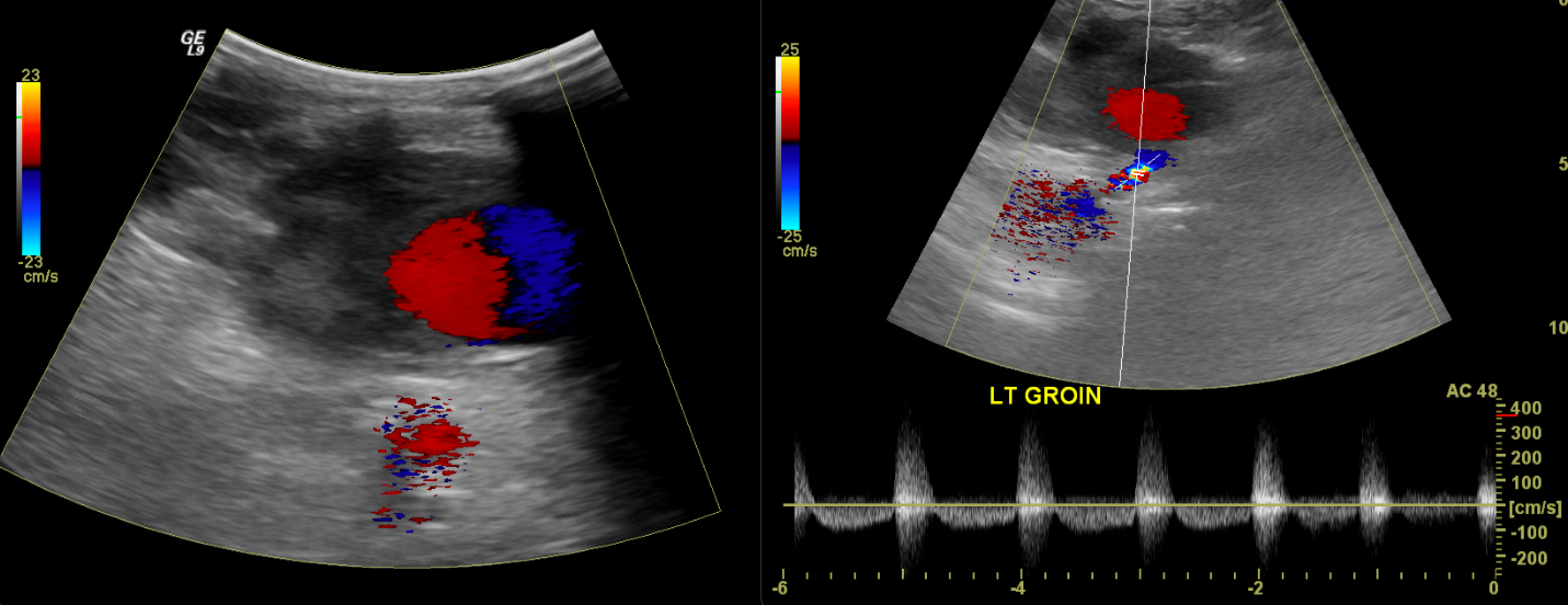 <p>Pseudoaneurysm